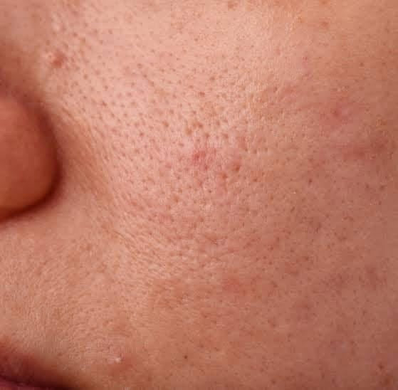 مجموعة علاج الاكني بالساليسيلك اسيد٧ قطع